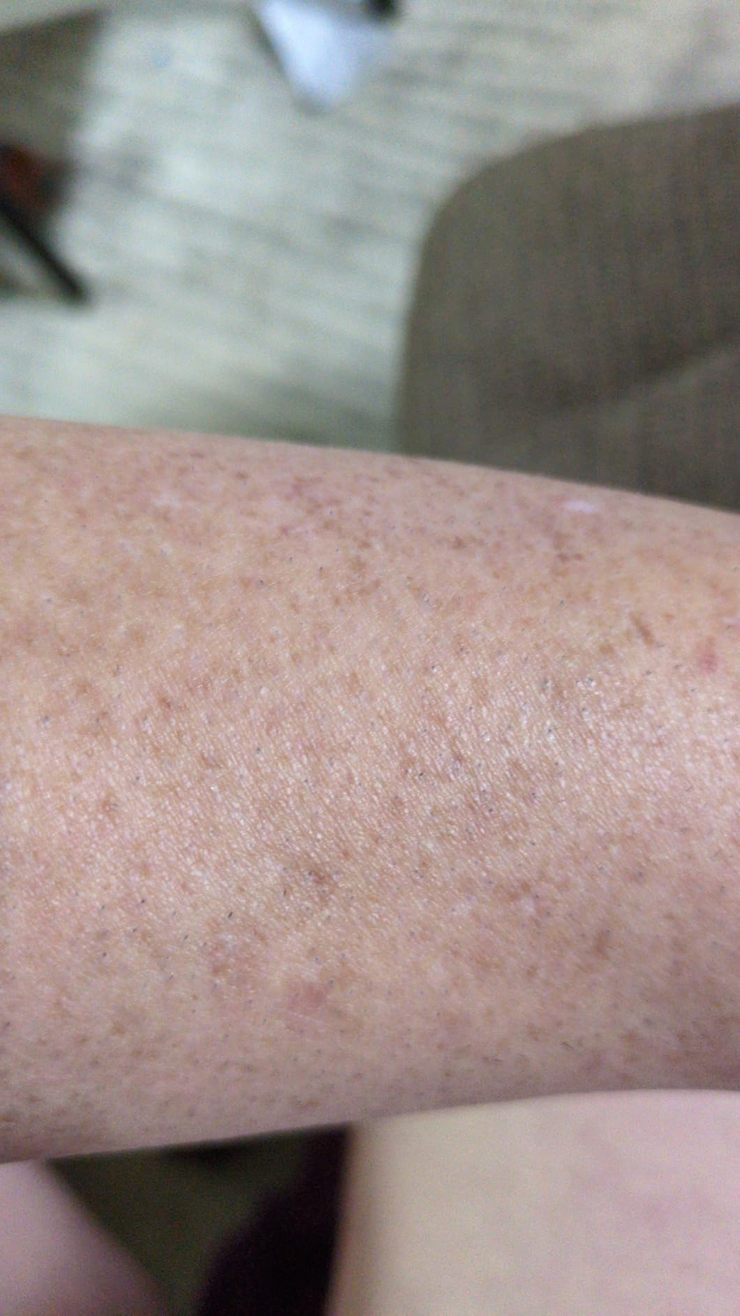 Nood™ Flasher Pro | IPL Laser Hair Removal Device, Forbes Best Product 2026 | Clinical-Grade Permanent Results At Home, CryoSoothe Tech with 5 Power Settings, Pain-Free 10 Min Sessions, Works Everywhere customer photo 1