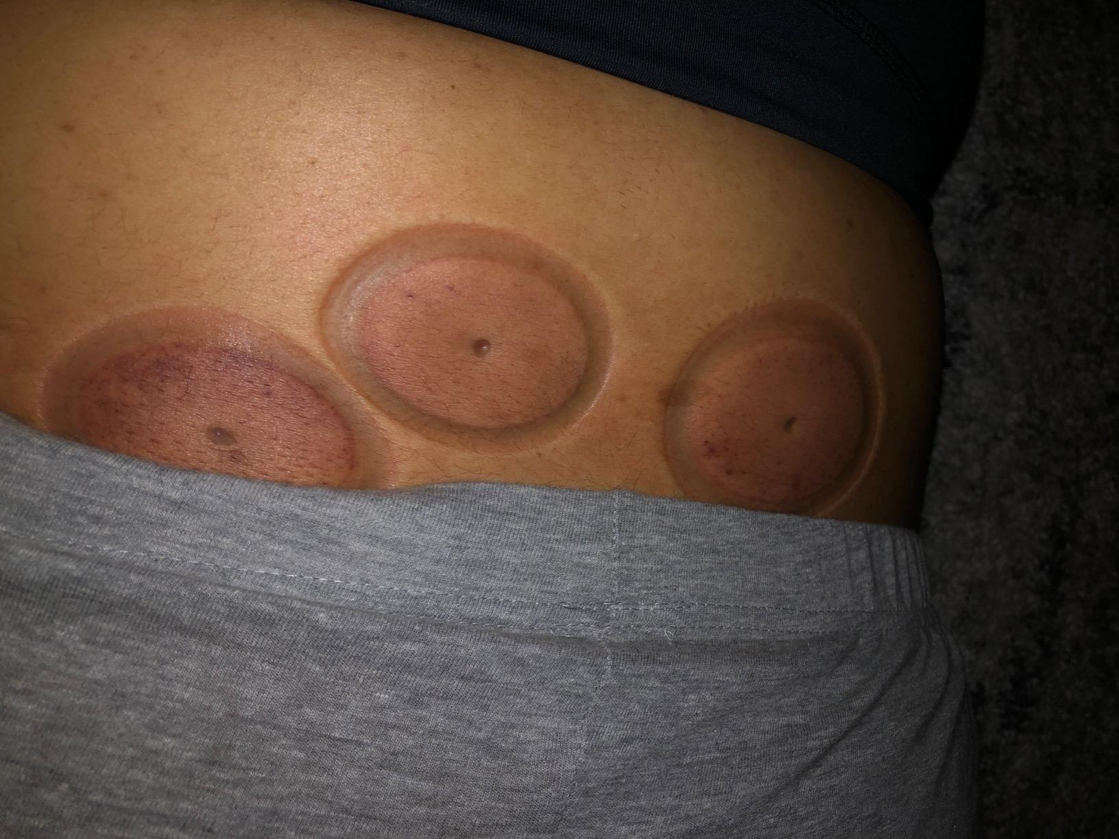 Cupping Kit for Massage Therapy Set with Pump 12 Massage Cups for Cellulite Reduction Muscle Back Pain Relief Physical Therapy customer photo 2
